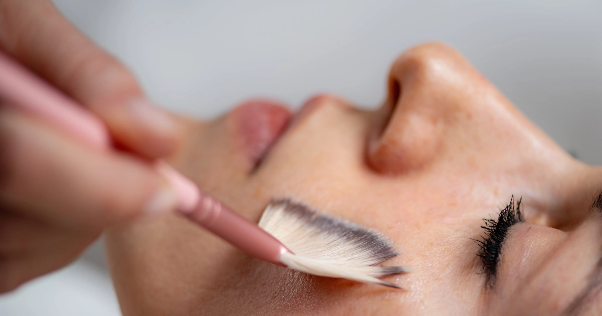 How VI Peel Targets Acne, Scars, and Hyperpigmentation Effectively